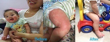 เอาชนะภูมิแพ้ผิวหนัง (Eczema) ด้วยพลังธรรมชาติ