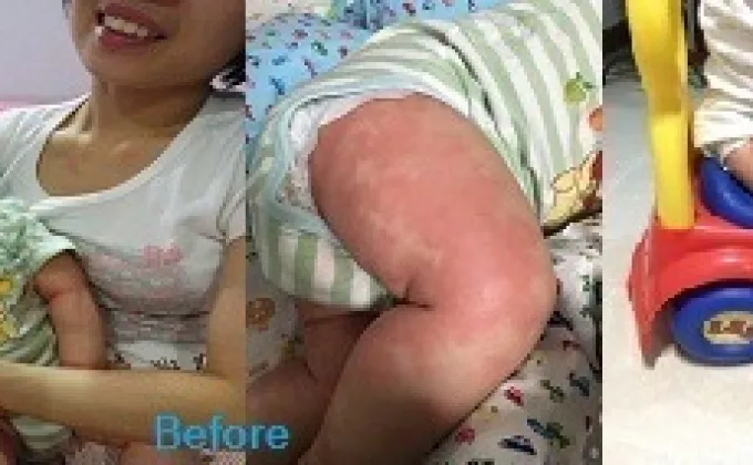 เอาชนะภูมิแพ้ผิวหนัง (Eczema)