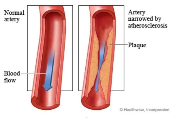 คนอ้วนเสี่ยงเป็นโรคหลอดเลือดหัวใจ ตีบหรือตัน (coronary artery disease)