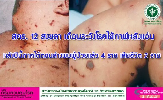 สคร. 12 สงขลา เตือนระวังโรคไข้กาฬหลังแอ่น