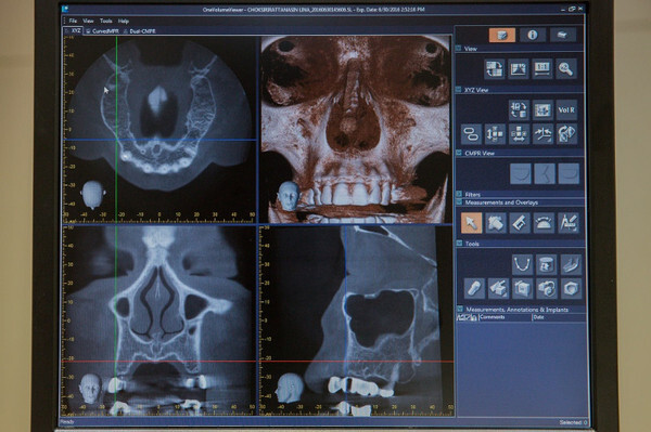 ศูนย์ทันตกรรม รพ.กรุงเทพ โชว์เทคนิค Computer Guided Implant Surgery ฝังรากฟันเทียมเพิ่มความแม่นยำได้อย่างตรงจุด