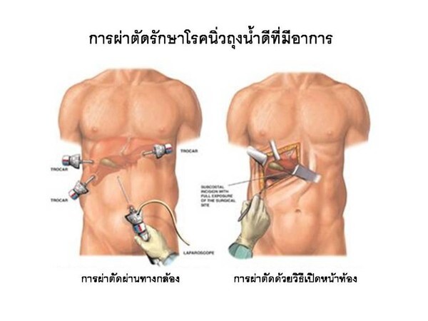 แพทย์เตือน 4F กลุ่มเสี่ยงนิ่วในถุงน้ำดี “ผู้หญิง-อ้วน-วัย40-กินแล้วจุกแน่นบ่อย”