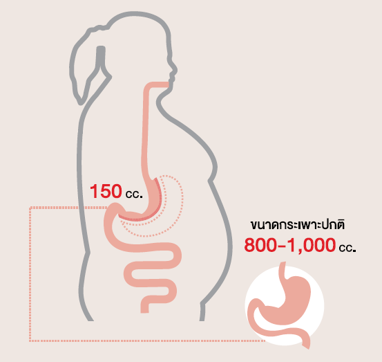 โรคอ้วน กระทบเมตาบอลิกซินโดรม...แถมเสี่ยงถุงน้ำรังไข่ในผู้หญิง