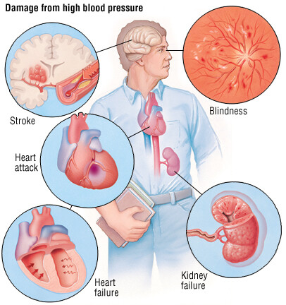 โรคความดันโลหิตสูง (Hypertension)