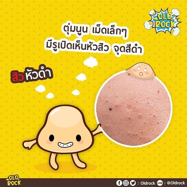 ทำอย่างไร เมื่อเป็น “สิวอุดตัน”