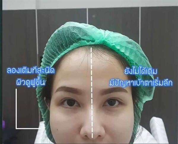 ไขทุกข้อข้องใจ ! ฉีดฟิลเลอร์ vs ฉีดไขมัน แตกต่างกันอย่างไร ?