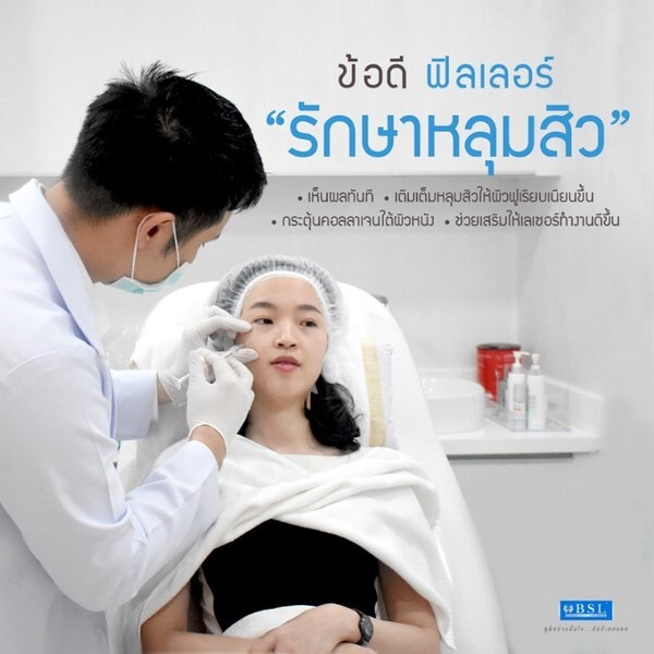 ข้อดี ของ ฟิลเลอร์ “รักษาหลุมสิว”