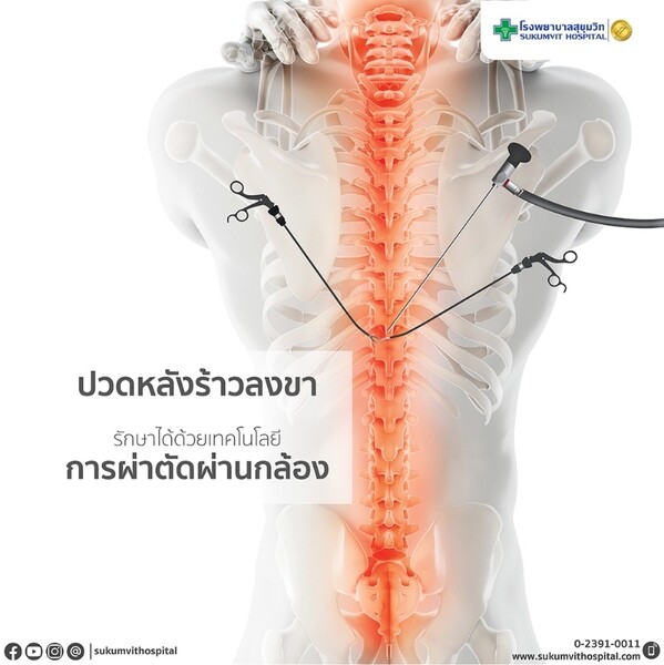 รพ.สุขุมวิท เน้นเทคโนโลยีการรักษาโรคปวดหลังด้วยการผ่าตัดผ่านกล้อง Full Endoscopic Surgery