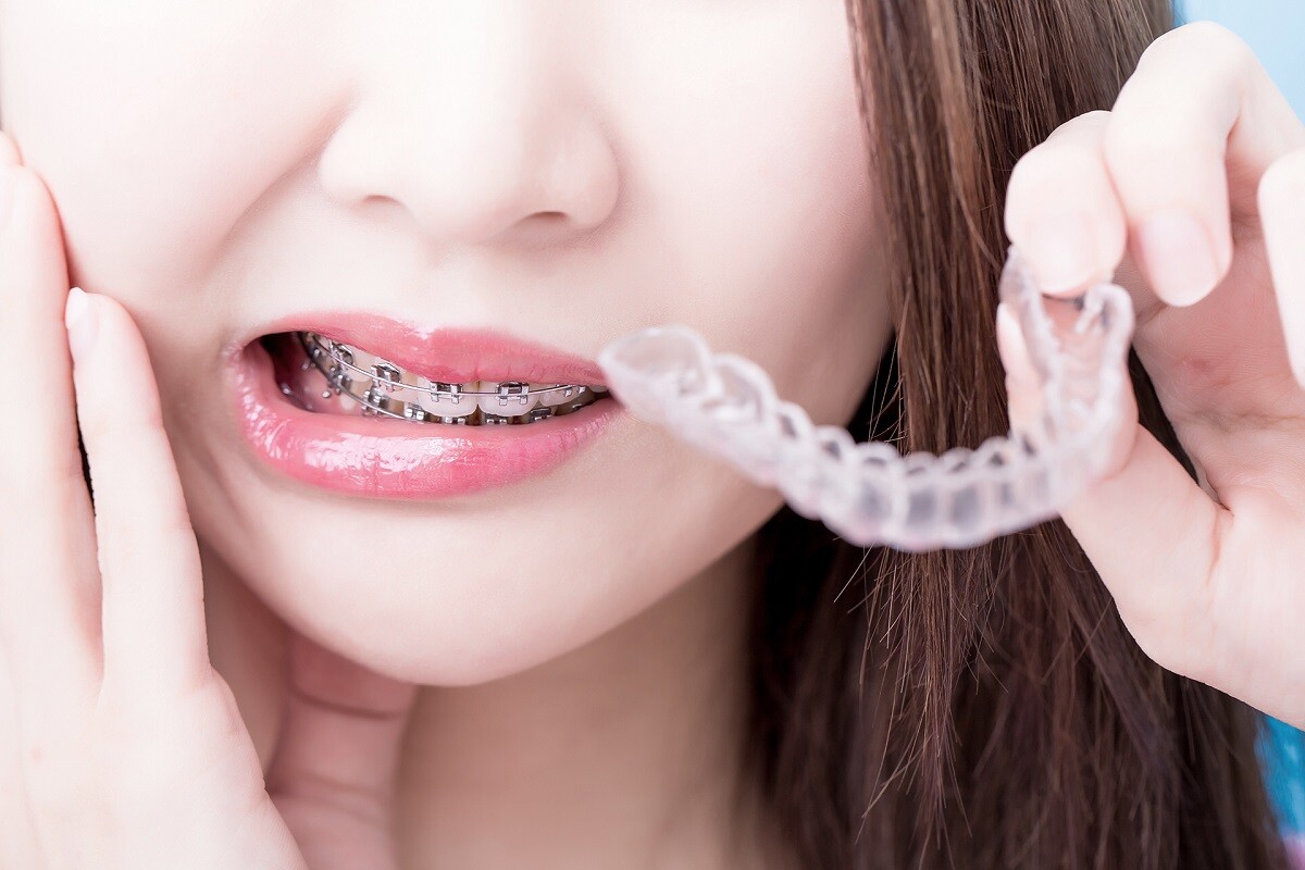 Invisalign อินวิซาไลน์ การจัดฟันแบบใส เพื่อฟันสวย โครงหน้าสมดุล จัดได้ทุกช่วงวัย ให้คุณยิ้มได้อย่างมั่นใจในทุกกิจกรรมของชีวิต