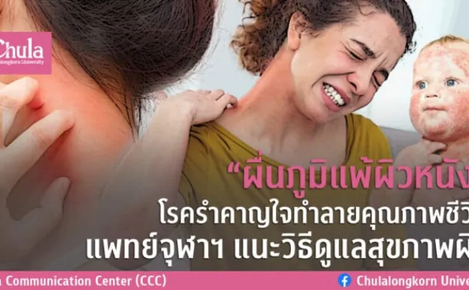 ผื่นภูมิแพ้ผิวหนัง โรครำคาญใจทำลายคุณภาพชีวิต