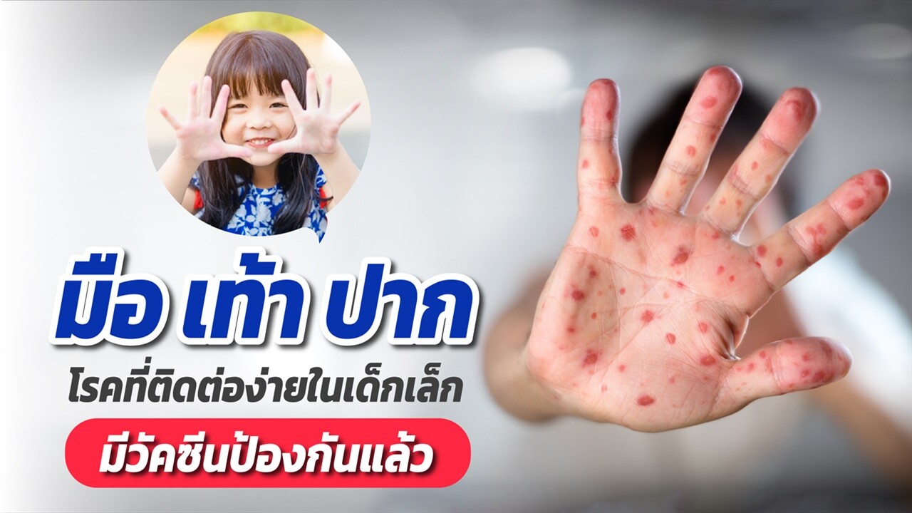 "มือ เท้า ปาก" โรคที่ติดต่อง่ายในเด็กเล็ก... มีวัคซีนป้องกันแล้ว