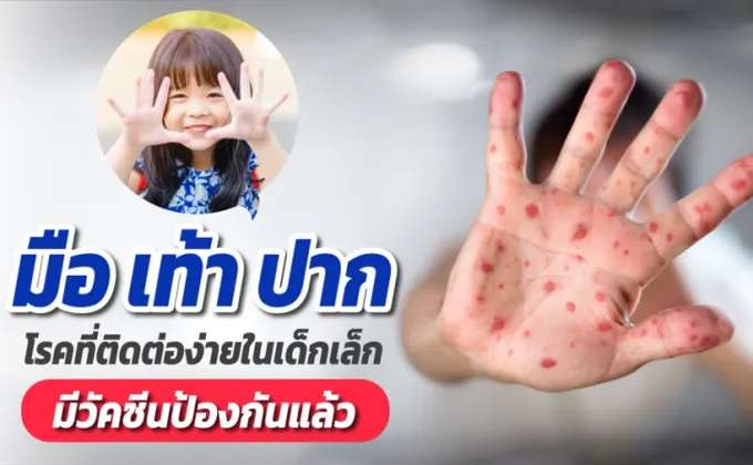 มือ เท้า ปาก โรคที่ติดต่อง่ายในเด็กเล็ก...