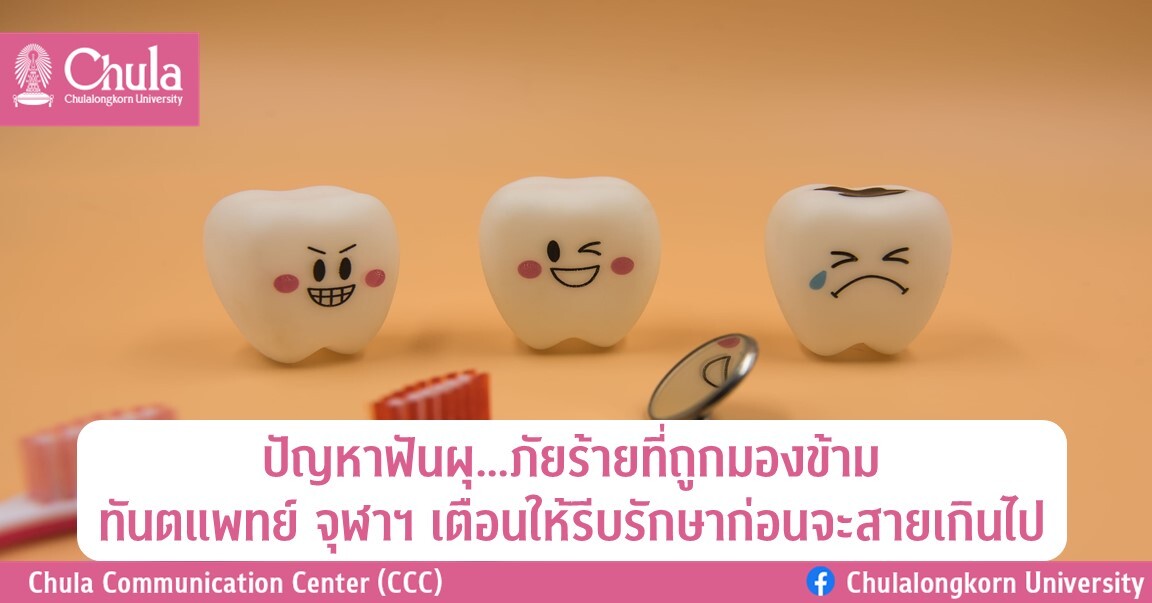 ปัญหาฟันผุ…ภัยร้ายที่ถูกมองข้าม ทันตแพทย์ จุฬาฯ เตือนให้รีบรักษาก่อนจะสายเกินไป