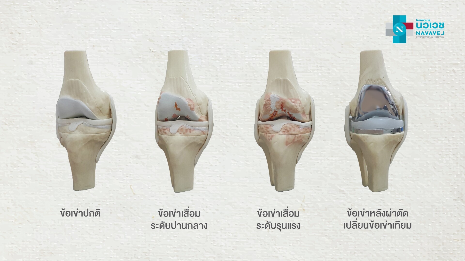 การรักษาข้อเข่าเสื่อม โดยไม่ผ่าตัด