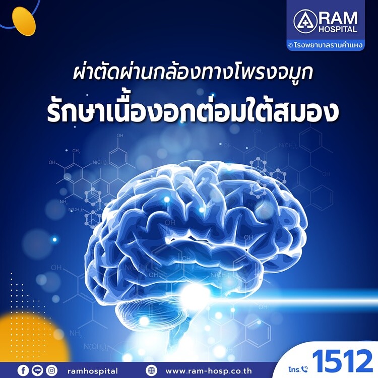 ผ่าตัดผ่านกล้องทางโพรงจมูก รักษาเนื้องอกต่อมใต้สมอง