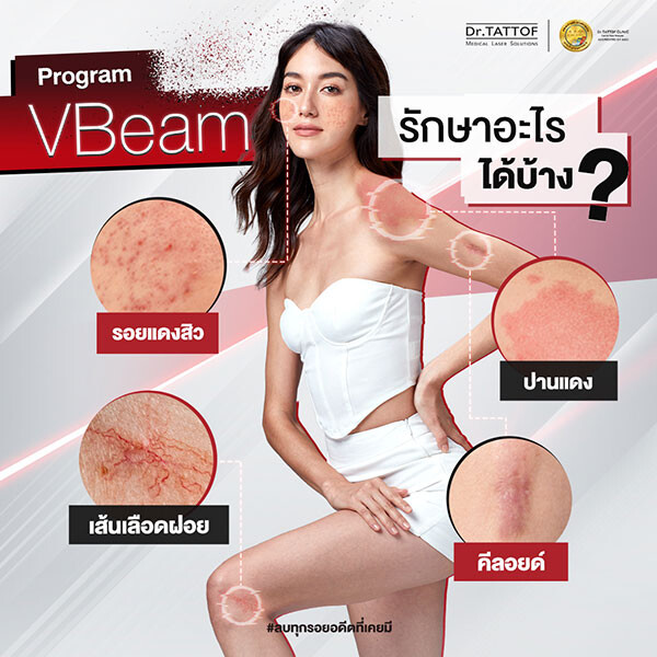 Dr.TATTOF มุ่งสู่ความเป็นผู้นำด้านการรักษาคีลอยด์ ด้วยโปรแกรม VBeam Laser