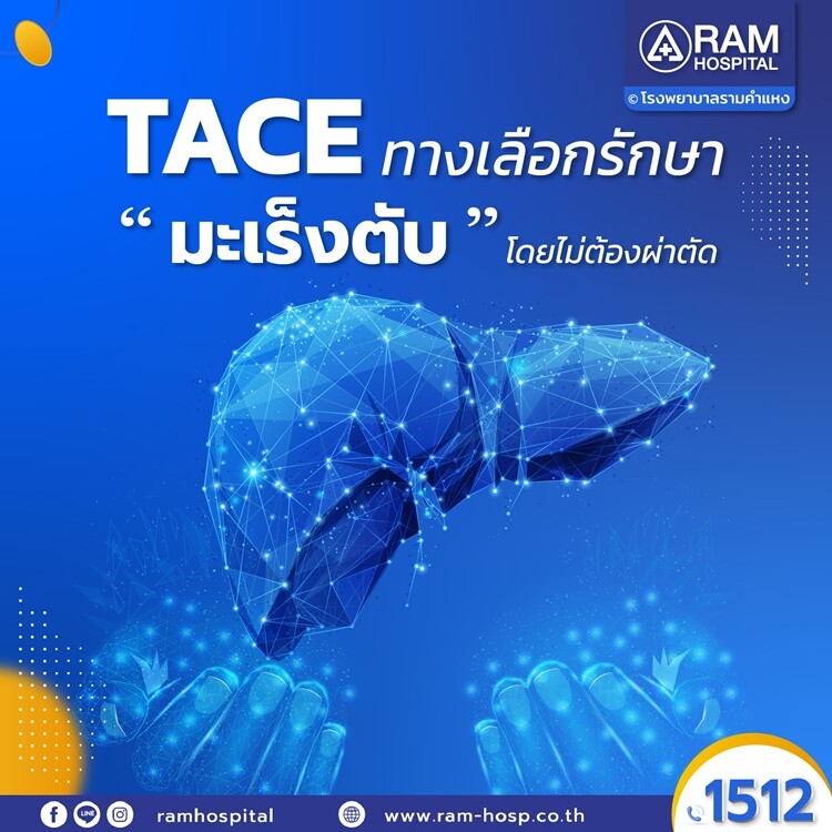 TACE ทางเลือกรักษา "มะเร็งตับ" โดยไม่ต้องผ่าตัด