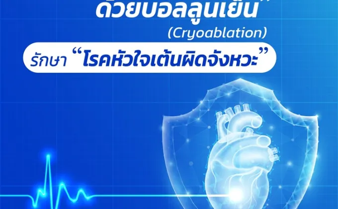 จี้ไฟฟ้าหัวใจด้วยบอลลูนเย็น (Cryoablation)