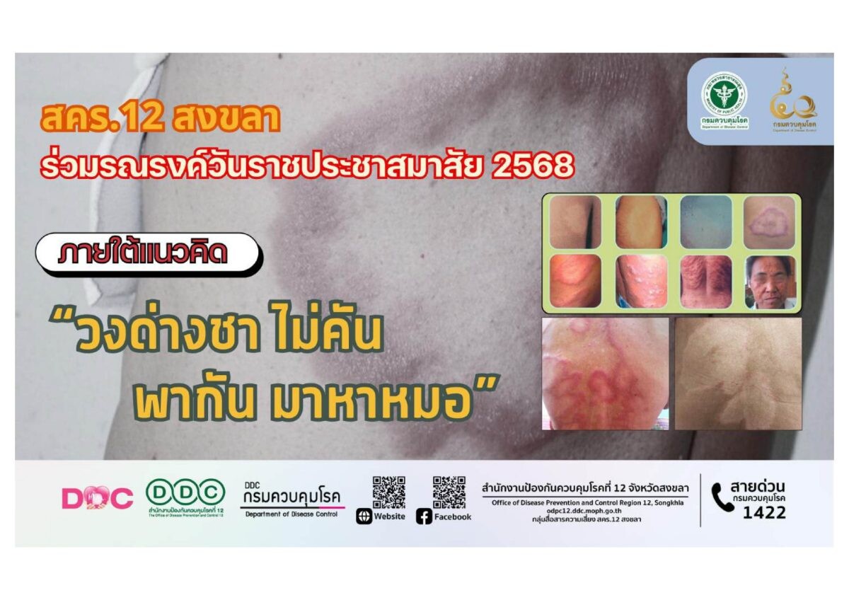 สคร.12 สงขลา ร่วมรณรงค์วันราชประชาสมาสัย 2568 ภายใต้แนวคิด "วงด่างชา ไม่คัน พากัน มาหาหมอ"