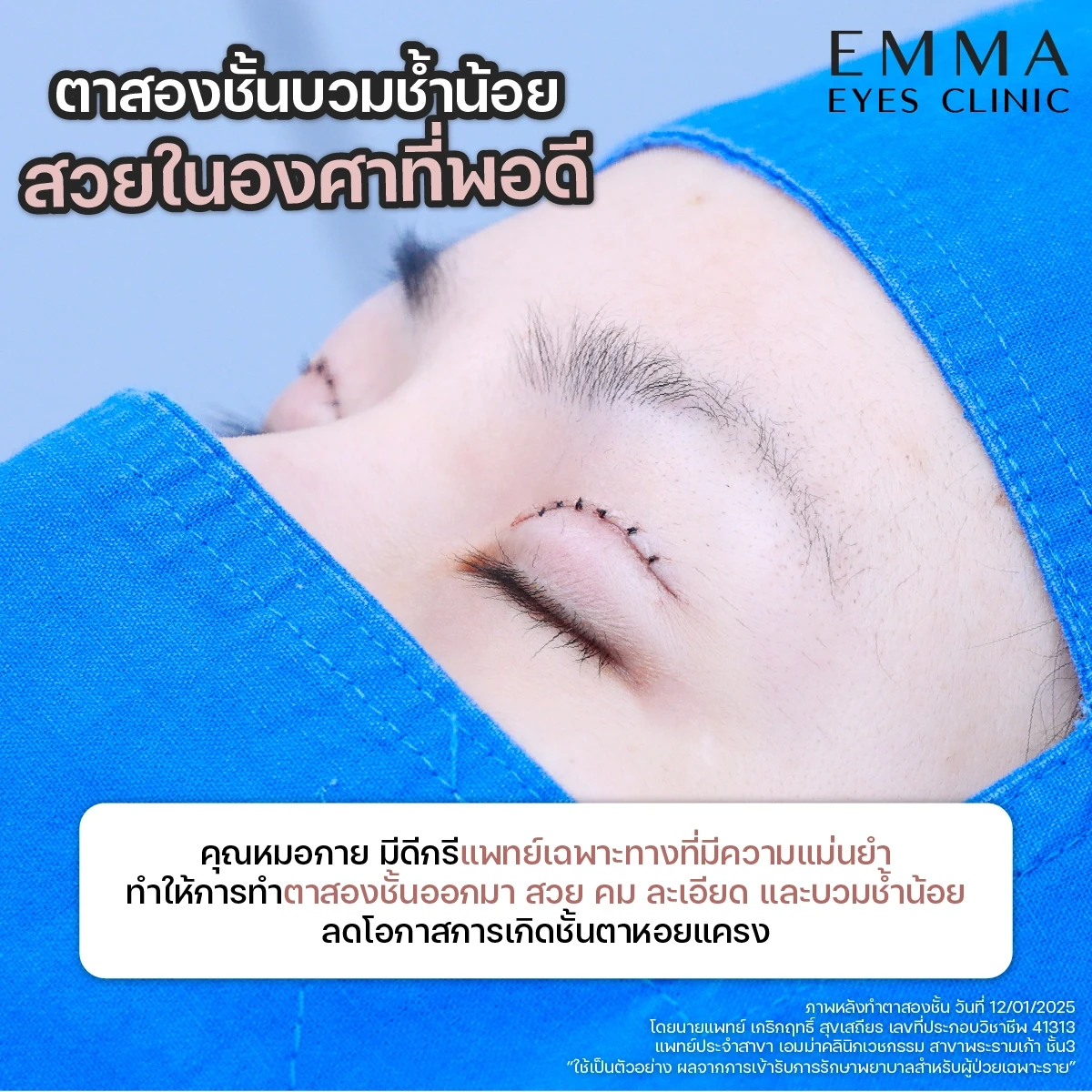 ออกแบบตาสองชั้นให้สวยคม โดยแพทย์เฉพาะทาง Plastic Surgery