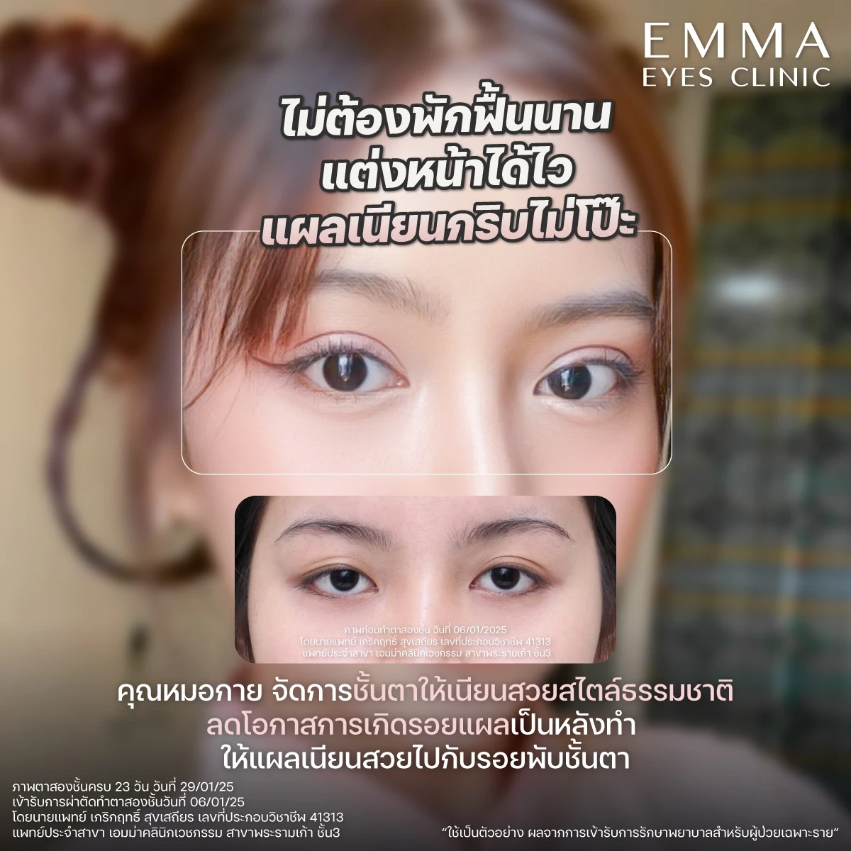 ออกแบบตาสองชั้นให้สวยคม โดยแพทย์เฉพาะทาง Plastic Surgery